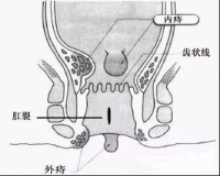 肛裂的原因?