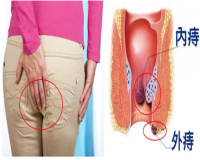 女生痔疮是什么样子的初期?