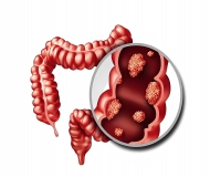 肠镜下检查查出息肉，要切掉吗?