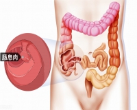 肠息肉摘除后为什么要复查?