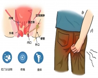做痔疮手术需要住院吗?