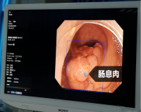 长了肠息肉有哪些症状?