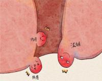 长痔疮时会有什么症状出现?