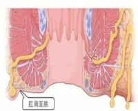 因痔疮耽误治疗的肛周脓肿！