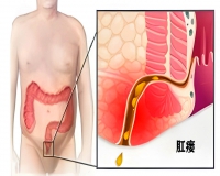 肛瘘发作后应进行治疗?