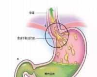 什么是反流性胃炎？反流性胃炎有哪些症状表现？