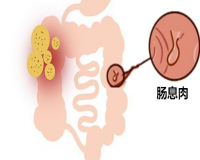 肠息肉切完后还会复发吗?