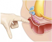 直肠指诊怎么做?