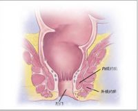 痔疮能挺一挺“自愈”吗?