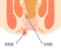 哪些人容易有痔疮呢?