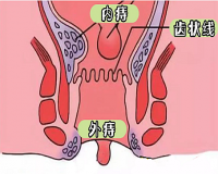 痔疮的表现症状是什么?