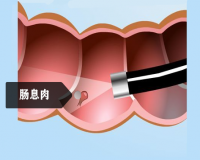 肠息肉切除后的护理?