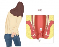 “凶险”的外痔是什么样子的?