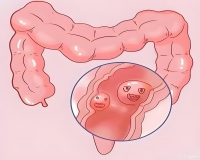 肠息肉切除多久复查一次?