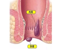 外痔常见症状有什么？