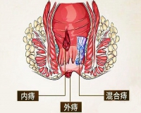 痔疮不想手术，可以试试这样做?