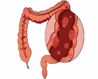 肠息肉到底是什么?