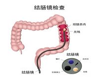 做肠镜痛苦吗?大概需要做多长时间?