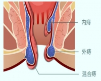 痔疮越长越多，有扩散的可能吗?