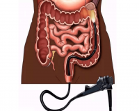 肠镜检查前，这几件事你要知道?