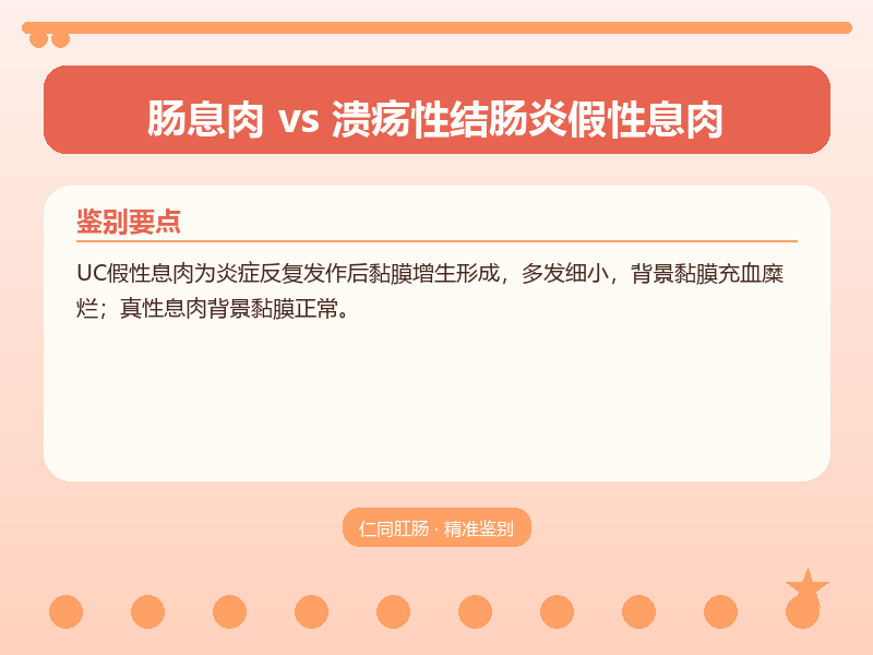 肠息肉与溃疡性结肠炎假性息肉的鉴别要点