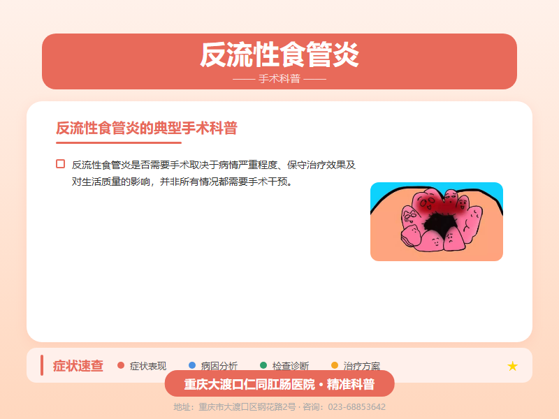反流性食管炎手术科普